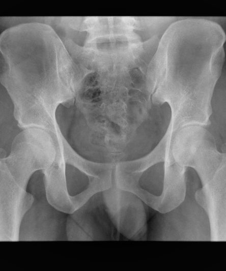 1 - 80kg Pelvis AP 65kV 16mAs