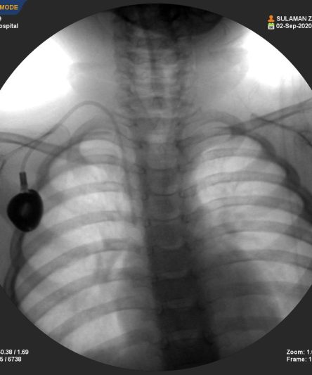 1y baby Chemo Port