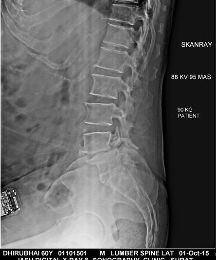 24- 90kg 88kV 95mAs SID100 L,spine Lat
