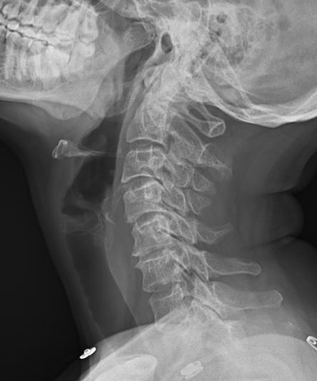 40 C Spine Lateral