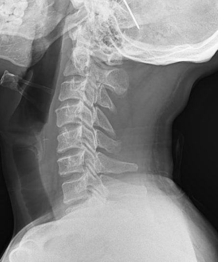 41 C spine Lateral