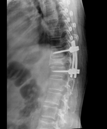 42 -Dorso Lumbar