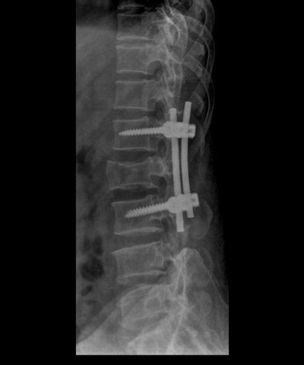 44 -Lumbar