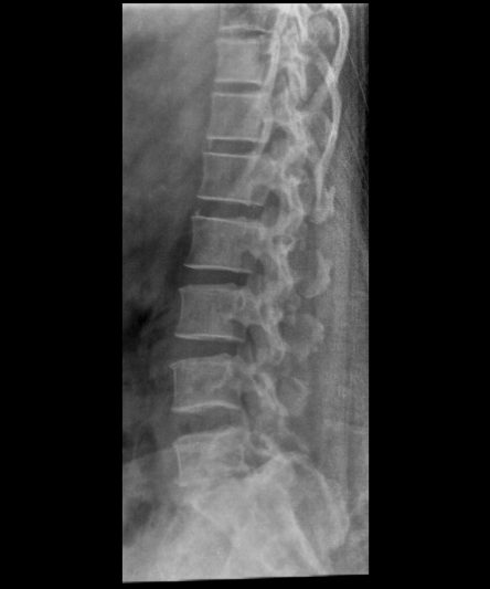 45 -Lumbar