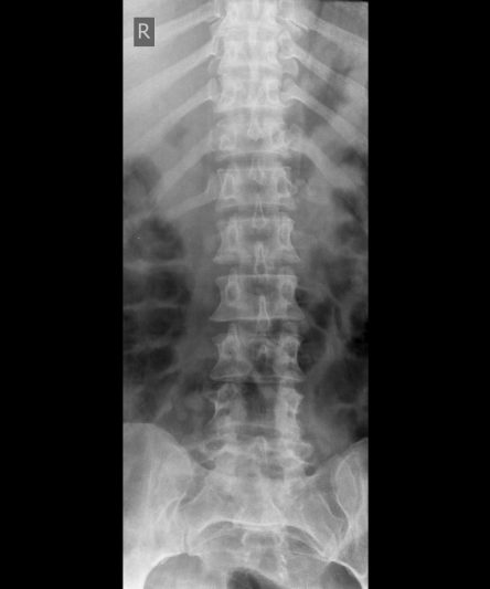 46 -Lumbar