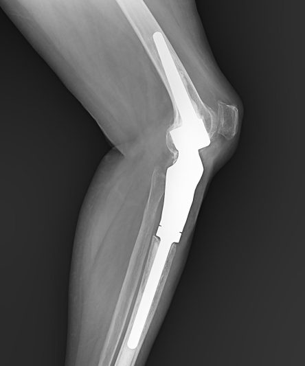 54Tumor Resection lateral