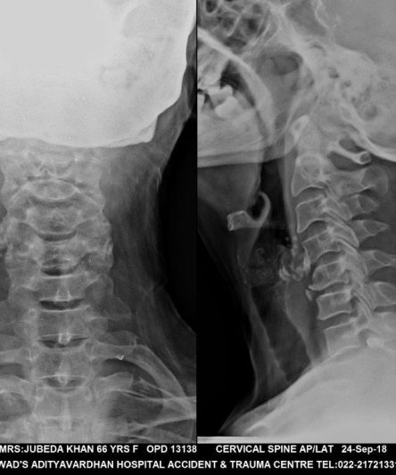 6 Cervical Spine