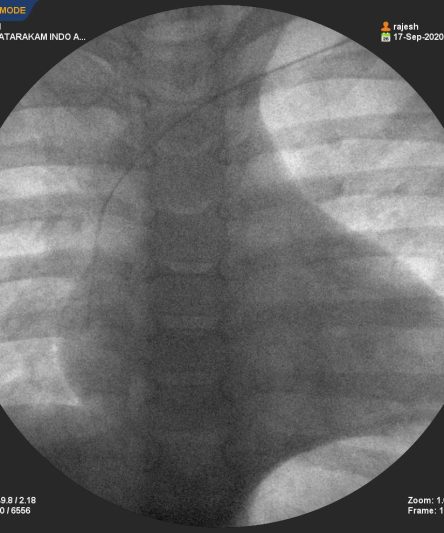 6Y BABY PICC Line