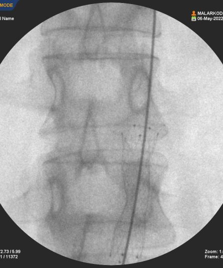 Aorta Stunt