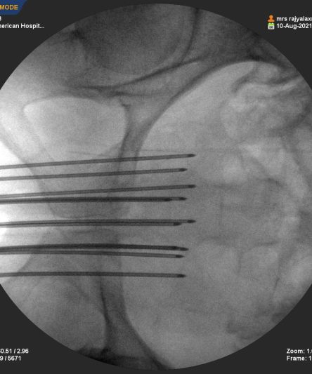Brachytherapy