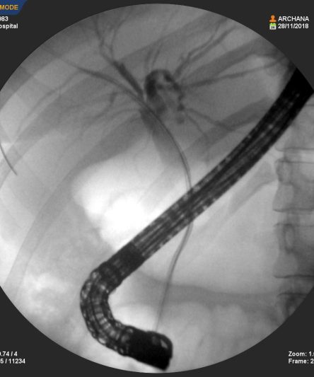 ERCP