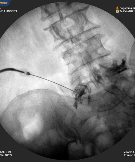 Epidural Block 22