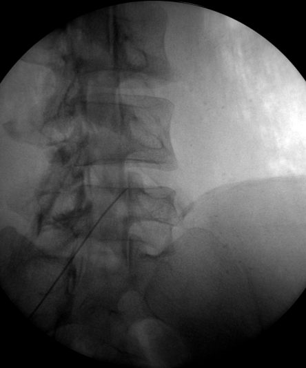 Facet Joint Injection
