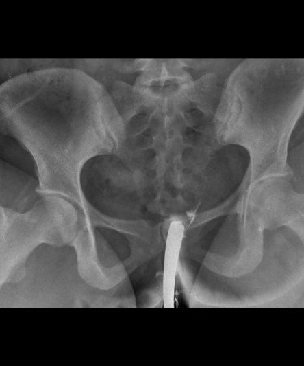 _HSG -Histerosalphingography