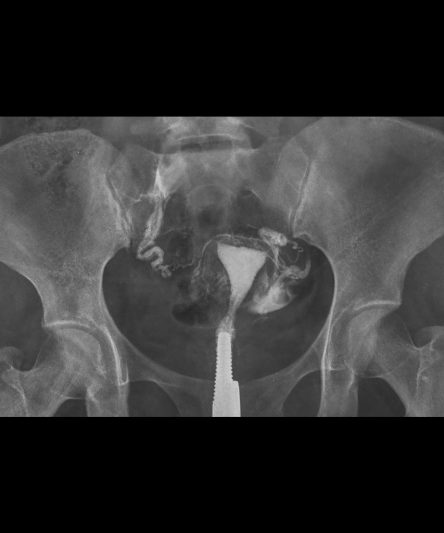 _HSG -Histerosalphingography AP-13