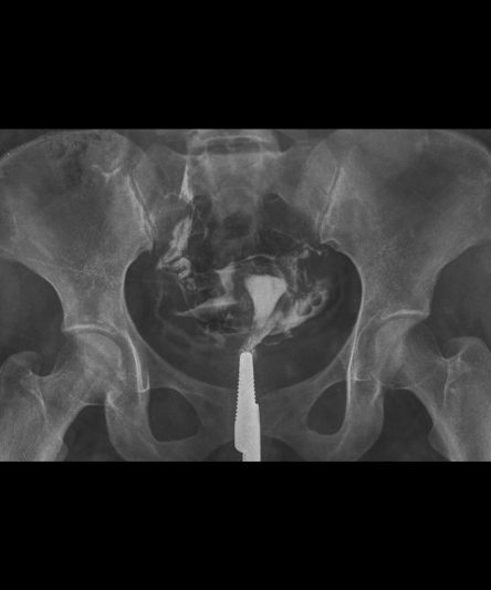 _HSG -Histerosalphingography AP-14