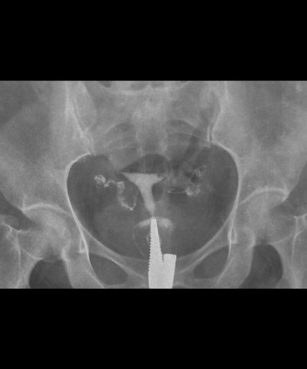 _HSG -Histerosalphingography AP-16