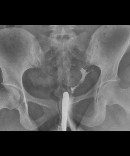 _HSG -Histerosalphingography AP-17