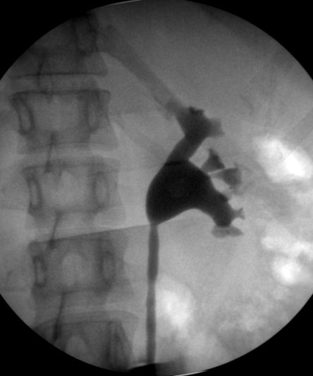PCNL 21