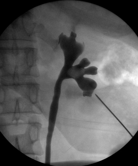 PCNL