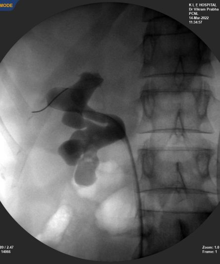 PCNL _ BL Stenting