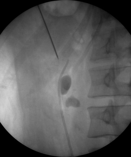 PCNL30 deg Oblique