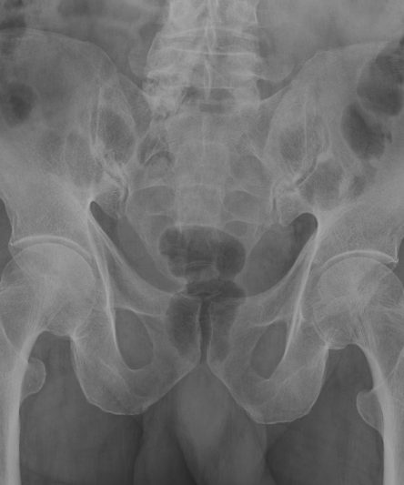 Pelvis AP