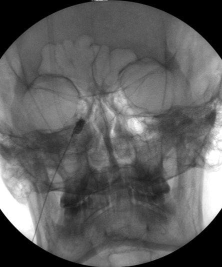 Trigeminal Block11
