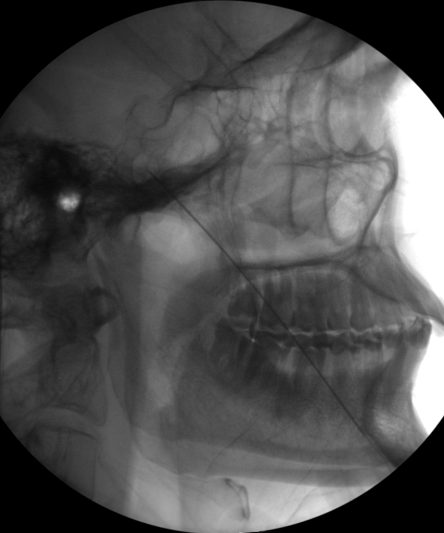 Trigeminal Block121